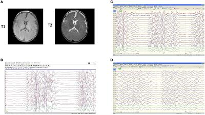 Case report: A novel STXBP1 splice variant and the landscape of splicing-involved STXBP1-related disorders